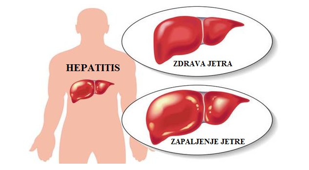 Hepatitis zapaljenje jetre